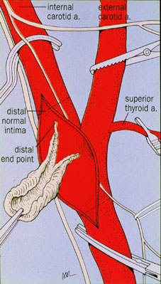 Carotid Endarterectomy