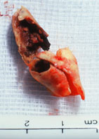 Carotid plaque