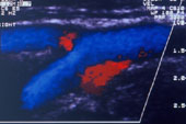 Colour Flow through carotid bifurcation