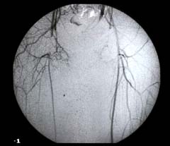 Digital Subtraction Angiogram