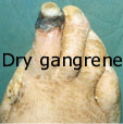 Dry gangrene