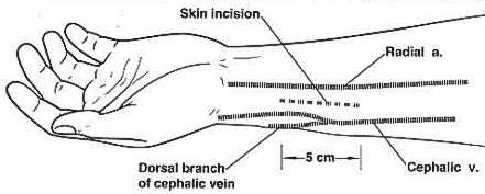 Radio-cephalic fistula