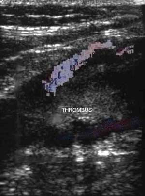 Thrombus in the vein