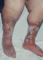 Venous Ulcers
